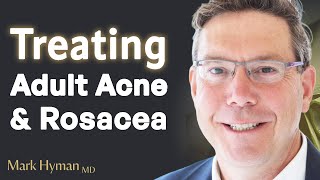 Treating Adult Acne amp Rosacea From The Inside Out [upl. by Nesahc]