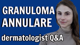 Granulomatosis with Polyangiitis Wegener’s granulomatosis  Symptoms Diagnosis Treatment [upl. by Samalla694]