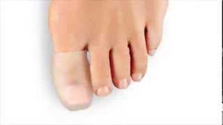 What is a Hammertoe [upl. by Atnahsa]