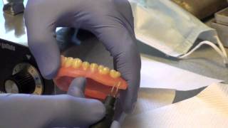 Denture Soft Reline Part 2 [upl. by Montague]