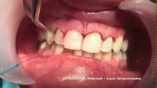 Laser Gingivectomy [upl. by Swanson]