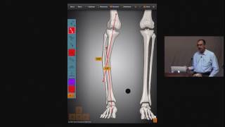 Osteotomy Rules [upl. by Nahraf]