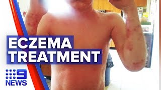 Life changing eczema treatment now approved for teenagers  Nine News Australia [upl. by Dnalrag]