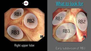 Lung Abscess  Pathology  Causes  Symptoms  Treatment  Nursing Lecture in Hindi MSN Part 1 [upl. by Mord794]