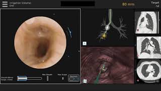 Pulmonary Tuberculosis in Hindi  Stages  Causes  Pathophysiology  Sign amp Symptoms [upl. by Ecyned923]