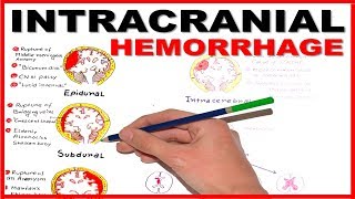 Intracranial Hemorrhage EpiduralSubduralSubarachnoid overview [upl. by Ardni]