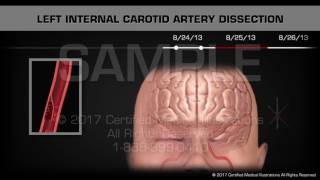 Carotid Artery Dissection Animated Timeline [upl. by Legge]