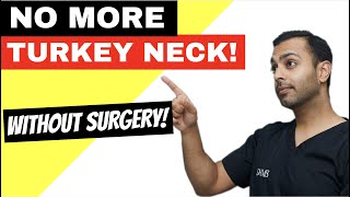 The nonsurgical necklift [upl. by Jeannie227]