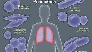 Treating CommunityAcquired Pneumonia [upl. by Ioyal]