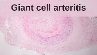 Giant cell arteritis Temporal arteritis Vasculitis Pathology  Usmle Step 1 [upl. by Melinde1]