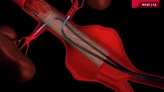 Fenestrated Endovascular Graft to Repair Abdominal Aortic Aneurysm [upl. by Lamaaj120]