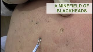 A Minefield of Blackheads  Dr Derm [upl. by Ytnom]