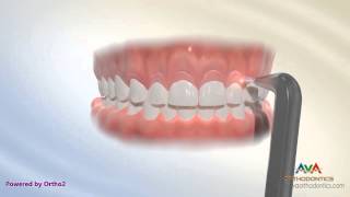 Surgical Treatment for Gummy Smile  Laser Gingivectomy [upl. by Varney]