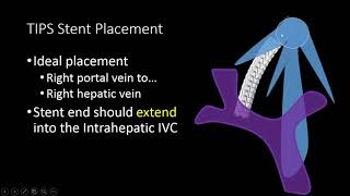 TIPS Stent US Doppler Evaluation [upl. by Ahar660]