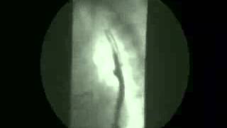 Video 8  Gastroesophageal reflux [upl. by Odnam]