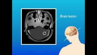 Extrapulmonary Aspergillosis – Type of Fungal Infection [upl. by Eceinhoj]