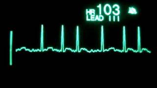 Atrial Fibrillation [upl. by Ahon]