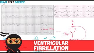 Rate and Rhythm  Ventricular Fibrillation [upl. by Dusen334]