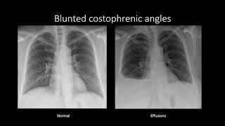 Pleural Effusions [upl. by Forsta]