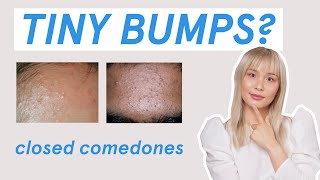 Why those tiny bumps AREN’T fungal acne [upl. by Rubens]