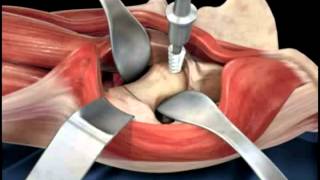 Distal Femur Locking Plates Fixation Procedure [upl. by Ntsyrk]