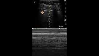 Pneumothorax Ultrasound Image Interpretation [upl. by Hsiri]