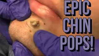 Chin Pimples And Zits  Facial Acne 2020  The BEST Chin Extractions [upl. by Htennek]