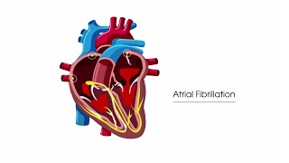 What is atrial fibrillation [upl. by Nytram]