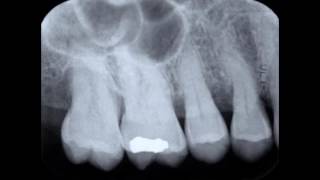 Paralleling Technique and Periapical Radiograph [upl. by Kendrah880]