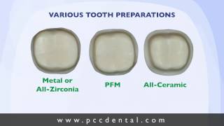 Ask Gordon Crown tooth preparation technique [upl. by Hijoung]