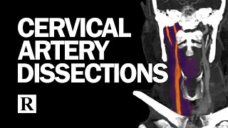 Cervical Arterial Dissections [upl. by Ahsenac]