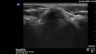 Suprainguinal approach to fascia iliaca block [upl. by Stock743]