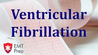 Ventricular Fibrillation ECG  EMTprepcom [upl. by Kennard174]