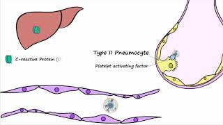 Bacterial Pneumonia  Pathogenesis [upl. by Seavir]