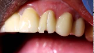 How to remove a zirconia crown [upl. by Tiga]