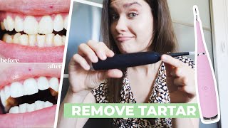 HOW TO REMOVE CALCULUS TARTAR PLAQUE AT HOME  Ultrasonic Tooth Cleaner Review  Does It Work [upl. by Joiner]