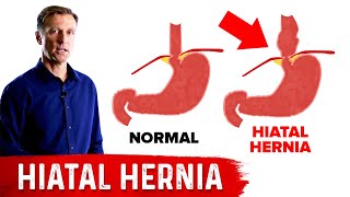 Hiatal Hernia Causes Symptoms Diagnosis Treatment [upl. by Susy]