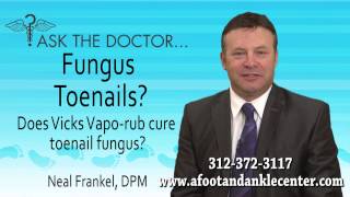 Does Vicks VapoRub Cure Toenail Fungus Chicago Lincolnwood Oak Brook IL  Podiatrist [upl. by Lillith]