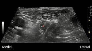 Femoral Nerve and Fascia Iliaca Blocks [upl. by Aehtla471]