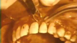 Gingivectomy Procedure to Eliminate Suprabony Pockets [upl. by Drarreg]