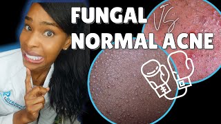 FUNGAL ACNE vs NORMAL ACNE [upl. by Orton422]