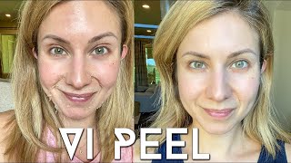 Vi PEEL done at Home  Step by Step Process  Before and Afters [upl. by Olracnaig298]