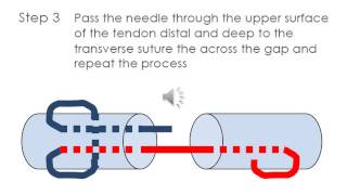 Flexor tendon repair  modified Kesser [upl. by Joly]