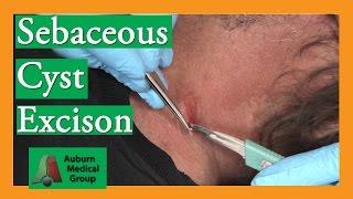 Sebaceous Cyst Removal  Auburn Medical Group [upl. by Dierolf]