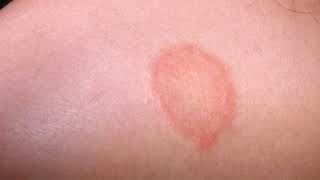 Difference Between Eczema and Ringworm [upl. by Seraphim]