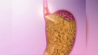 Acid Reflux Natural Remedies [upl. by Twelve253]