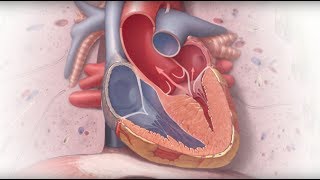 Hypertrophic Cardiomyopathy Guide to Understanding the Condition [upl. by Narag106]