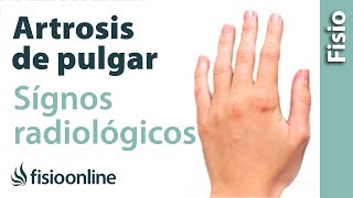 Rizartrosis o artrosis del pulgar  Signos radiológicos [upl. by Koppel]