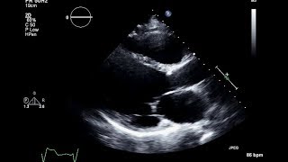 Ischemic Cardiomyopathy 2D Echocardiogram [upl. by Lula]