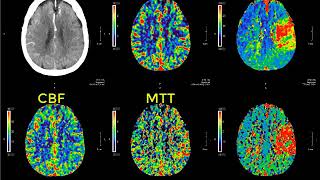 Introduction to CT perfusion before Call [upl. by Ateuqal898]